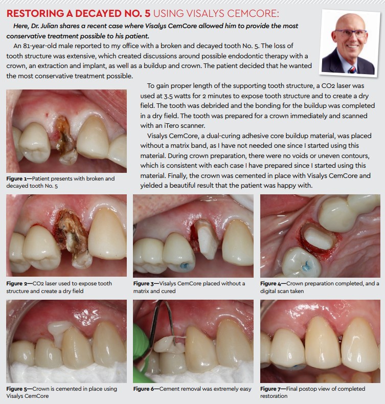 restoring decayed no 5 using vialys cemcore